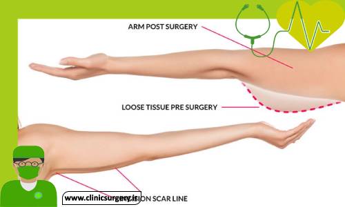 براکیوپلاستی یا جراحی لیفت بازو